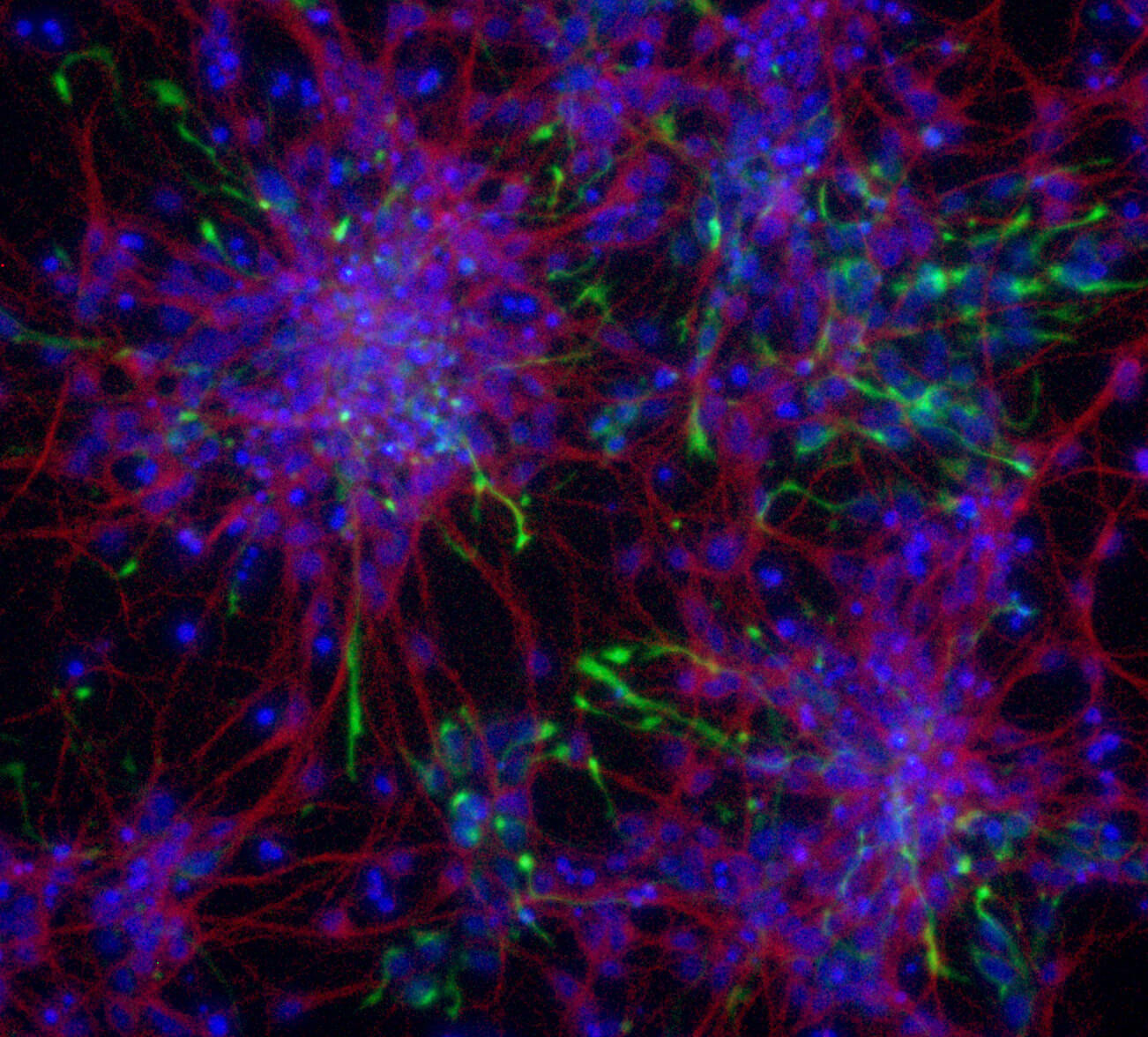 Malattia di Huntington: i nuovi approcci terapeutici al Convegno di Palm Springs. Biomarcatori per il monitoraggio della terapia.
